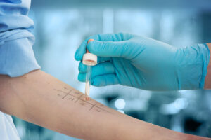 Skin prick allergy test at Neoalta Allergy & Sinus Clinic in Vashi, Navi Mumbai