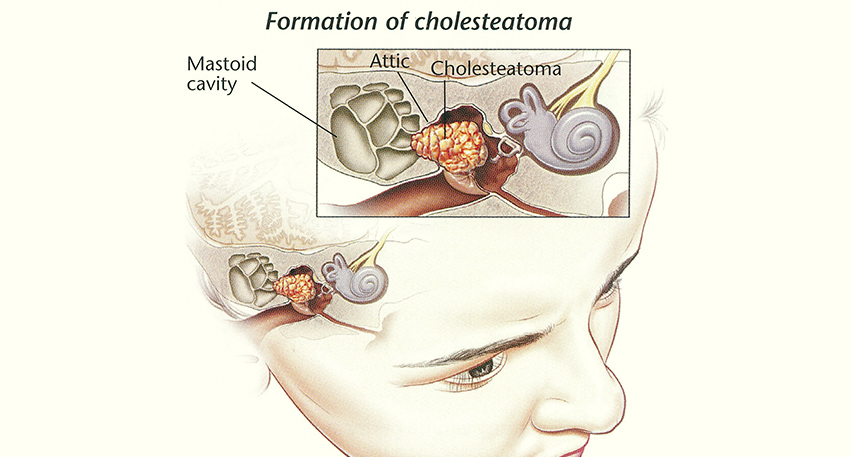 Radical Mastoidectomy Cholesteatoma Radical Mastoidectomy Cholesteatoma