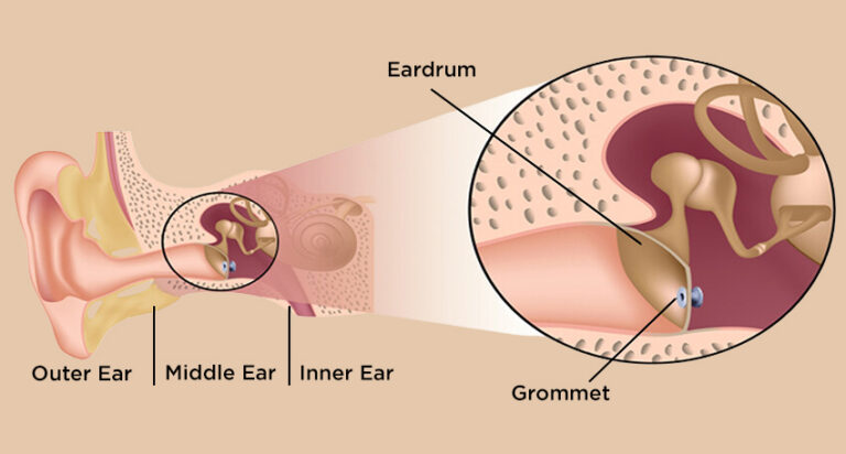 Middle Ear Rattle Middle Ear Fluid Treatment Vashi | Glue Ear, Navi Mumbai