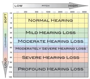 Audiogram chart showing normal, mild, moderate, severe and profound hearing loss levels in dB