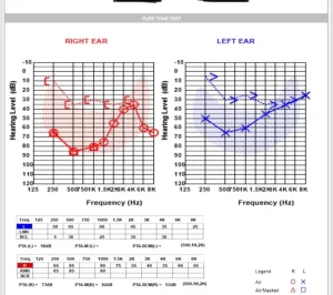 Audiogram showing conductive hearing loss with a clear air–bone gap