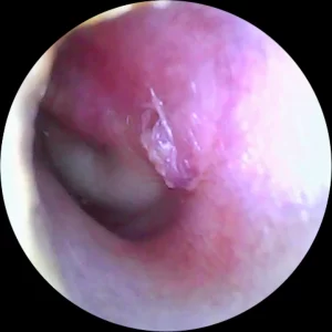 ear infection showing fluid behind ear drum-causing hearing loss