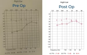 Pre-operative and post-operative audiograms showing air-conduction improvement and reduced air–bone gap after mastoidectomy with tympanoplasty type III.