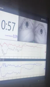 VNG test eye movement tracking on monitor showing nystagmus patterns