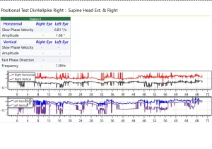 Sample VNG test report graph showing nystagmus and eye movement results